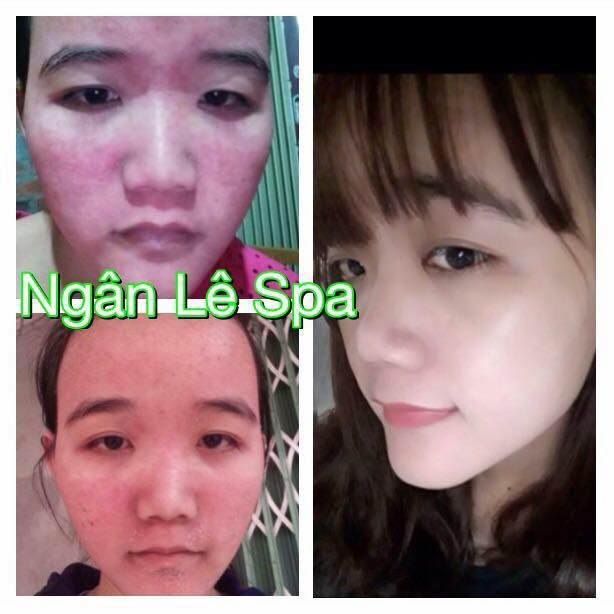 Quy trình trị liệu chuẩn y khoa tại Ngân Lê Spa