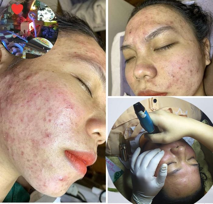 Hình ảnh trị liệu chuyên sâu tại Viện Da Lành