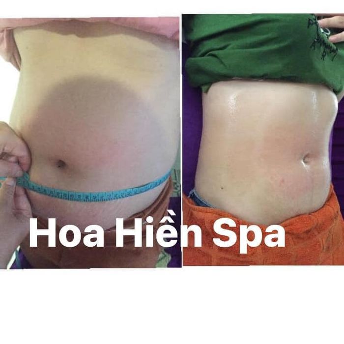 Quy trình điều trị chuẩn y khoa tại Hoa Hiền Spa