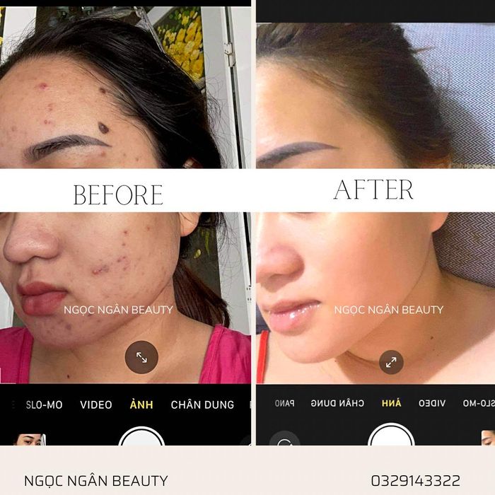 Quy trình trị liệu công nghệ cao tại Ngọc Ngân Beauty