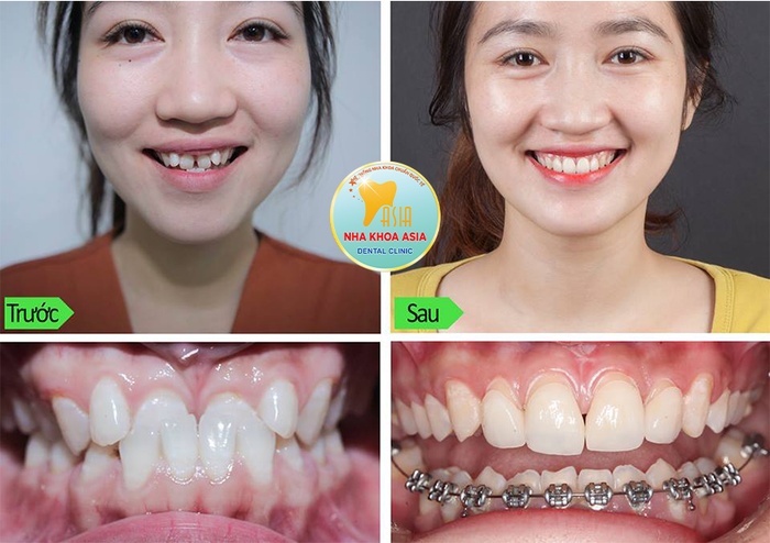 Nha Khoa Asia ảnh 2 - Hình ảnh về quy trình niềng răng tại Nha khoa Asia, một địa chỉ uy tín với đội ngũ bác sĩ chuyên môn cao và trang thiết bị tiên tiến.