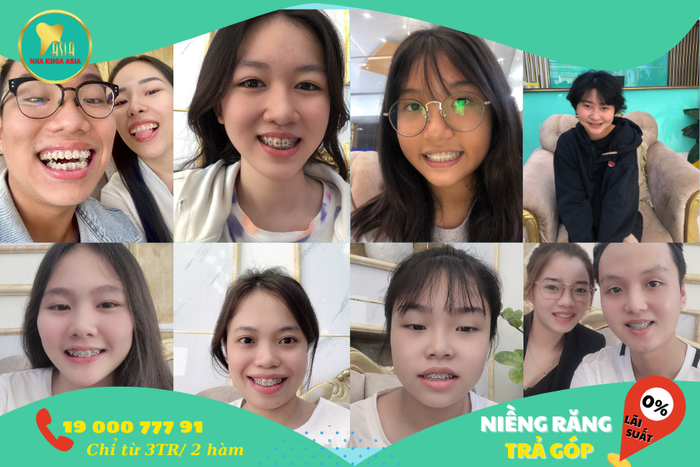 Nha Khoa Asia ảnh 1 - Minh họa hình ảnh của dịch vụ niềng răng tại Nha khoa Asia, nơi sự chăm sóc tận tình và chuyên nghiệp luôn được đặt lên hàng đầu.