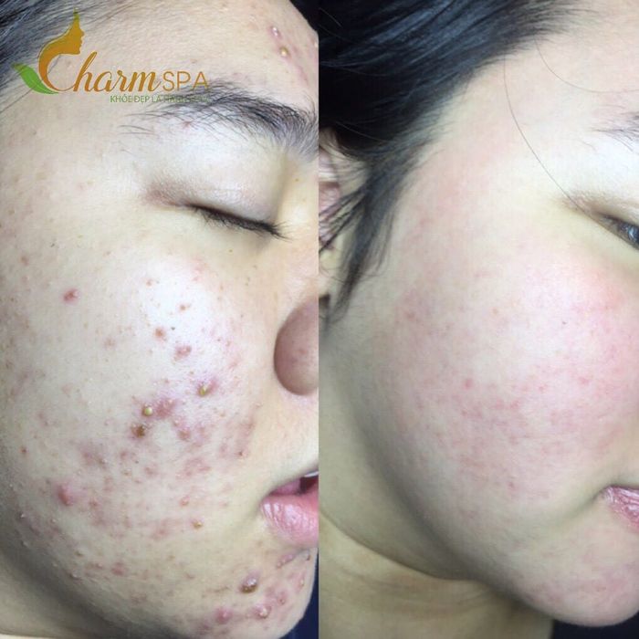 Hình ảnh trị liệu chuyên nghiệp tại Charm Spa