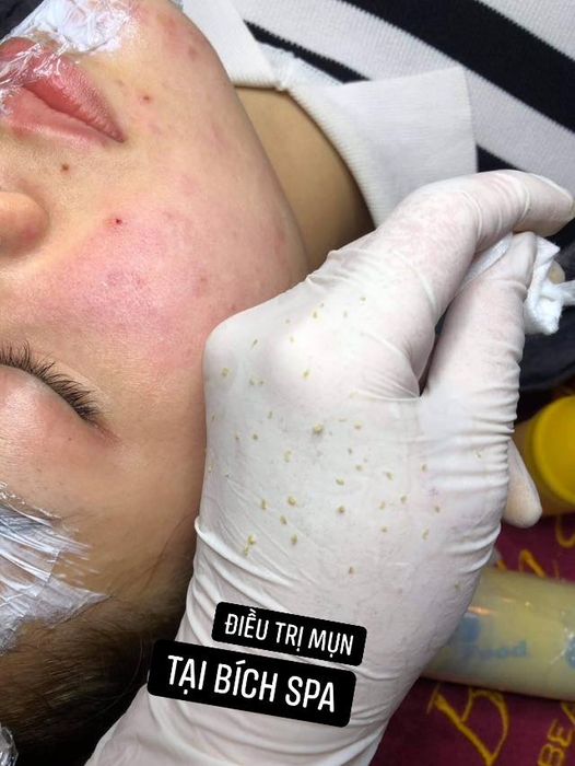 Quy trình trị mụn chuyên nghiệp tại Bích Spa