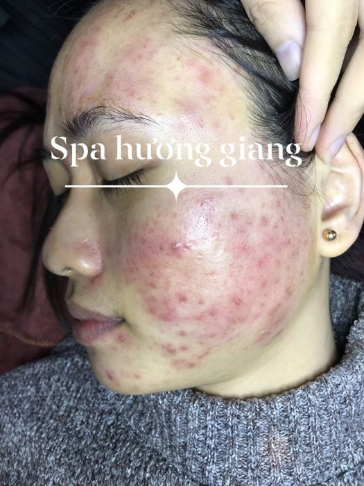 Hình ảnh quy trình trị mụn chuyên nghiệp tại Hương Giang Spa