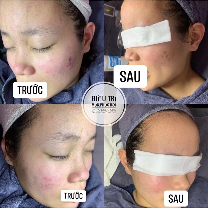 Dung Chu Skincare & Cosmetics - Hình ảnh thực tế về quy trình trị liệu chuyên nghiệp