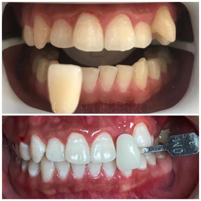 Hình ảnh quy trình bọc răng sứ chuyên nghiệp tại Nha Khoa Bảo Minh - Ảnh 2