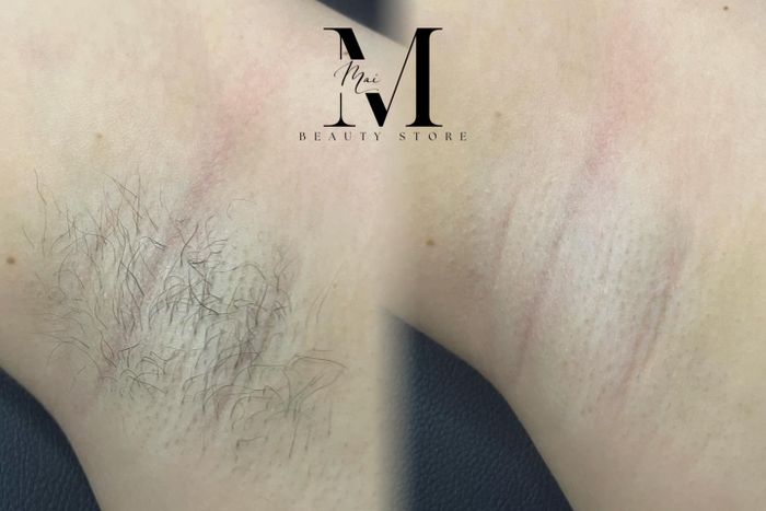 Hình ảnh quy trình waxing chuẩn Úc tại Mai Waxing Store