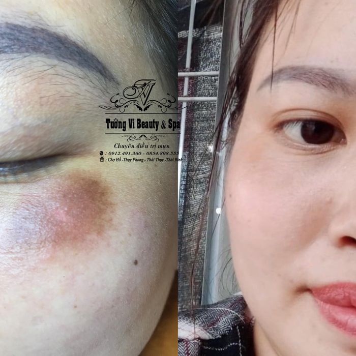 Hình ảnh quy trình trị liệu chuyên nghiệp tại Tường Vi Beauty Spa