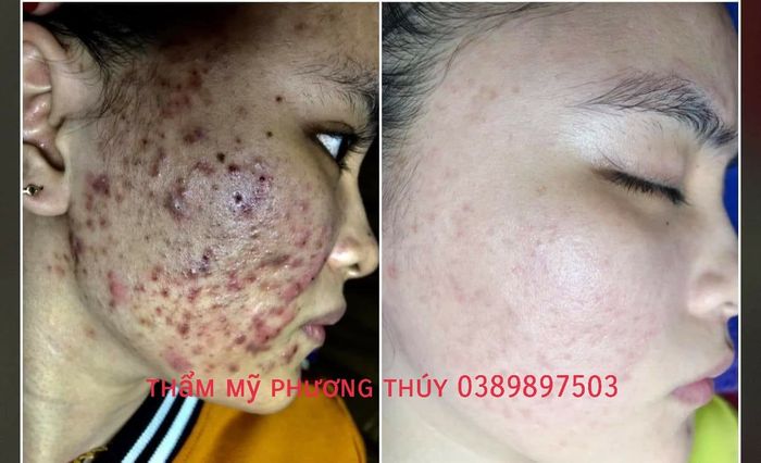 Hình ảnh trị liệu da chuyên nghiệp tại Phương Thúy Beauty