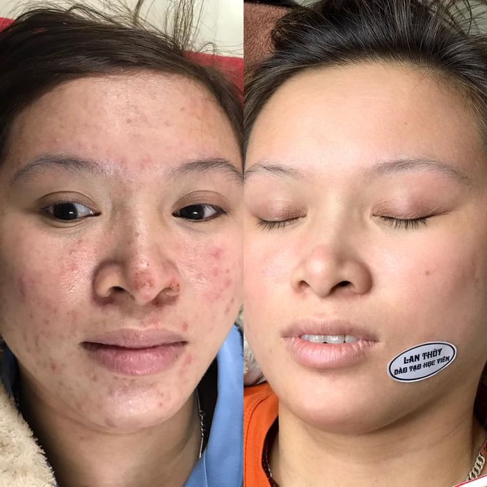 Hình ảnh quy trình trị liệu da chuẩn y khoa tại Lan Thùy Spa