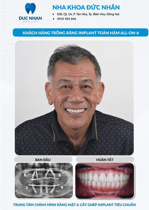 Quy trình trồng răng Implant chuyên nghiệp tại Nha Khoa Đức Nhân