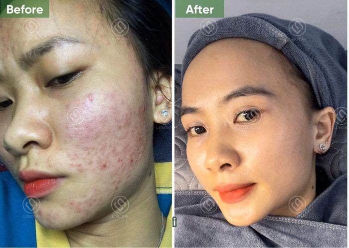 Quy trình nặn mụn chuyên nghiệp bằng công nghệ ánh sáng sinh học