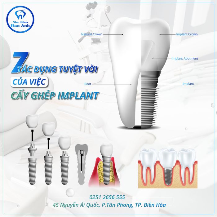 Quy trình trồng răng Implant chuyên nghiệp tại Nha Khoa Đan Anh