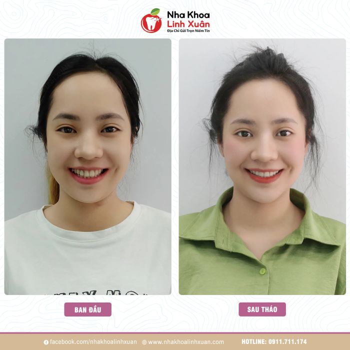 Nha Khoa LINH XUÂN ảnh 2