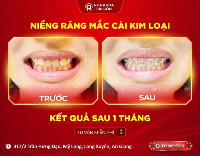 Bộ sưu tập hình ảnh kết quả điều trị ấn tượng tại Nha Khoa Sài Gòn - Ảnh 2