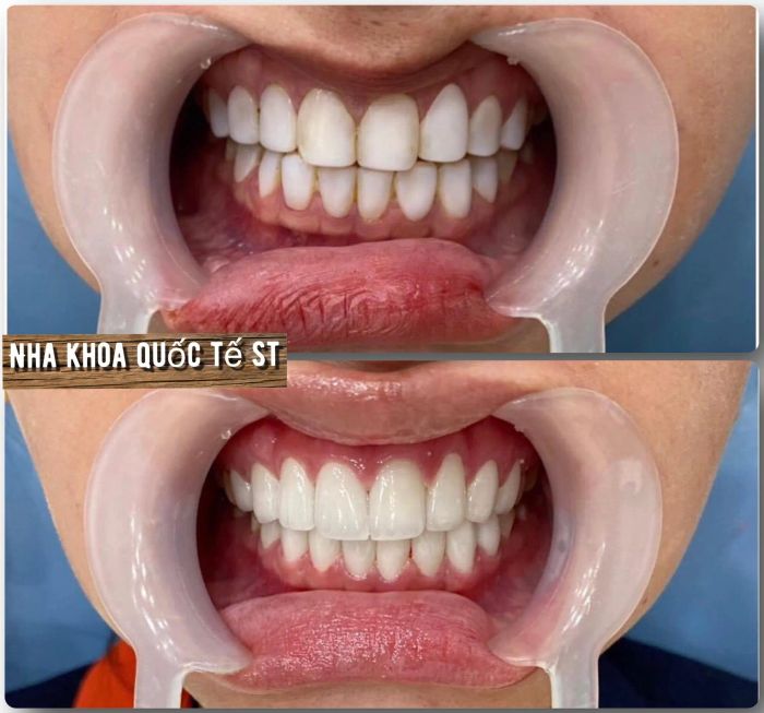 Hệ thống phòng điều trị đạt chuẩn quốc tế tại Nha khoa Quốc Tế ST