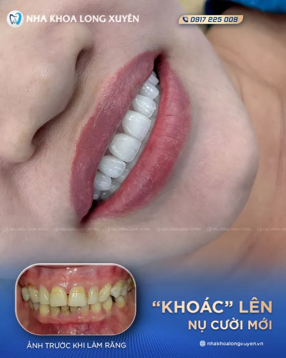Hình ảnh thực tế về quy trình điều trị chuyên nghiệp tại Hệ Thống Nha Khoa Long Xuyên - Ảnh 2