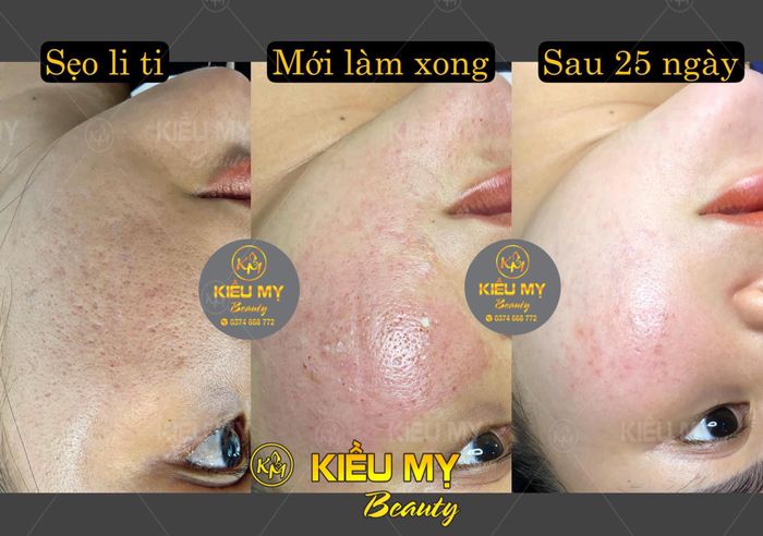 Hình ảnh quy trình trị liệu chuyên nghiệp tại Kiều Mỵ Beauty & Academy