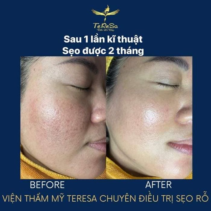 Hình ảnh quy trình trị sẹo chuyên nghiệp tại Viện Thẩm Mỹ Te Re Sa