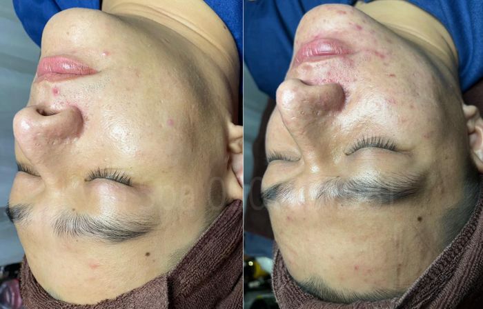 Hình ảnh quy trình trị sẹo chuyên nghiệp tại Kym Spa