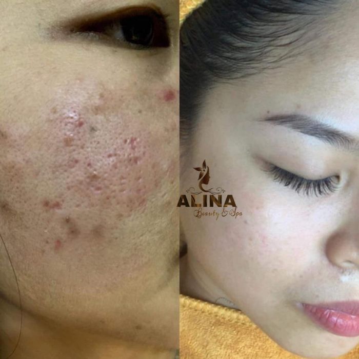 Hình ảnh liệu trình chăm sóc da chuyên sâu tại ALINA Beauty & Spa