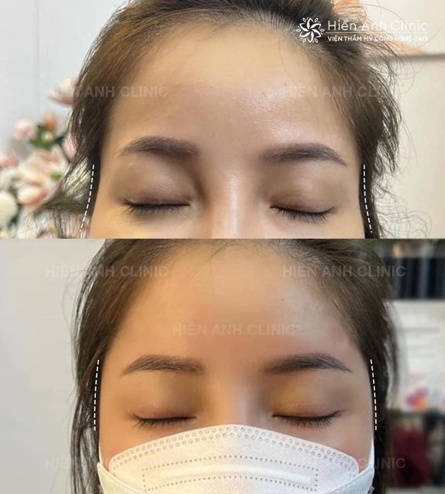 Kết quả phun xăm ấn tượng tại Hiền Anh Clinic