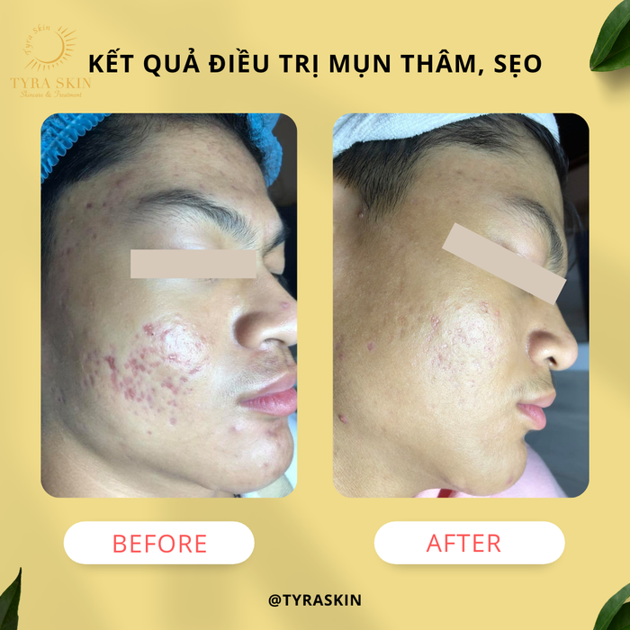 Tyra Skin hình ảnh 1