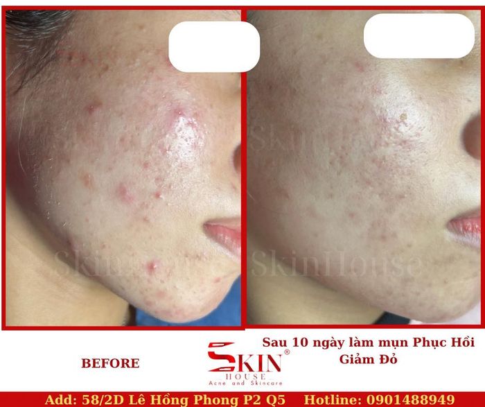 Skin House - Hình ảnh quy trình trị liệu chuyên nghiệp