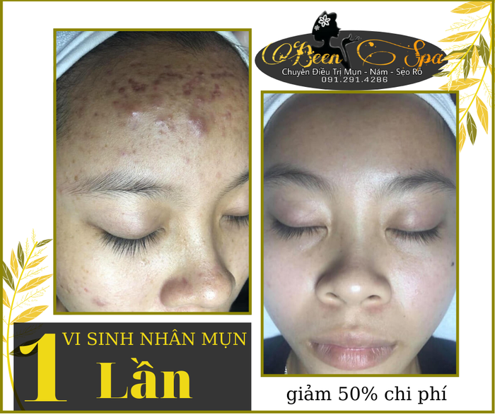 Been Spa - Hình ảnh quy trình trị mụn chuẩn y khoa