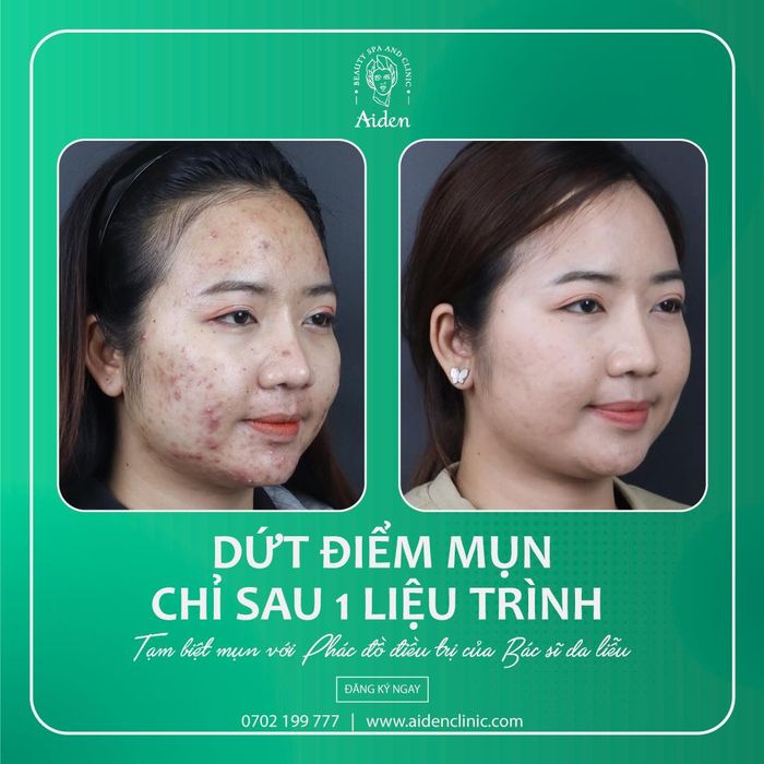 Aiden Beauty Spa & Clinic - Hình ảnh quy trình trị mụn chuyên nghiệp