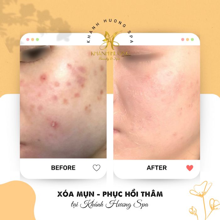 Khánh Hương Spa - Không gian sang trọng với công nghệ trị mụn hàng đầu