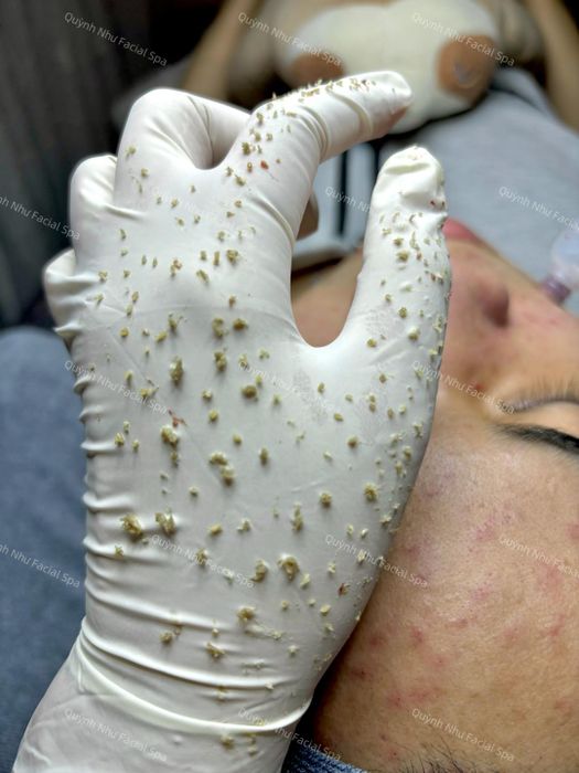 Quỳnh Như Facial Spa - Quy trình trị mụn chuẩn y khoa