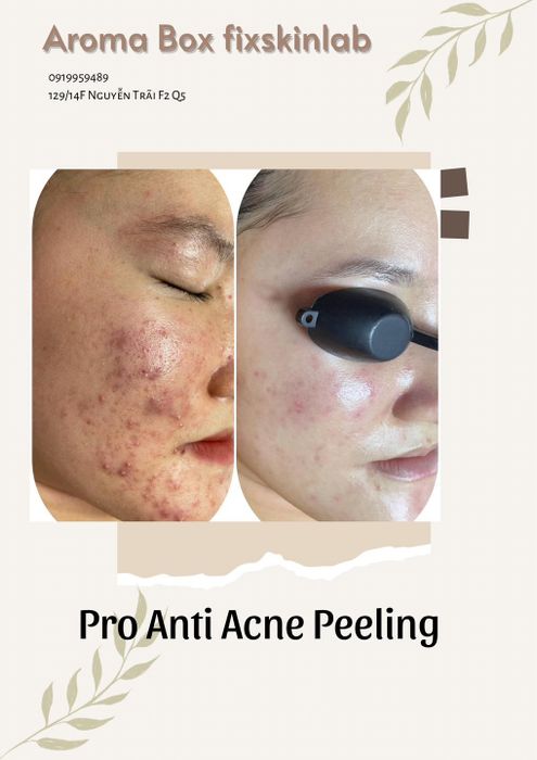 Aroma Box Spa - Quy trình trị mụn nhẹ nhàng không đau