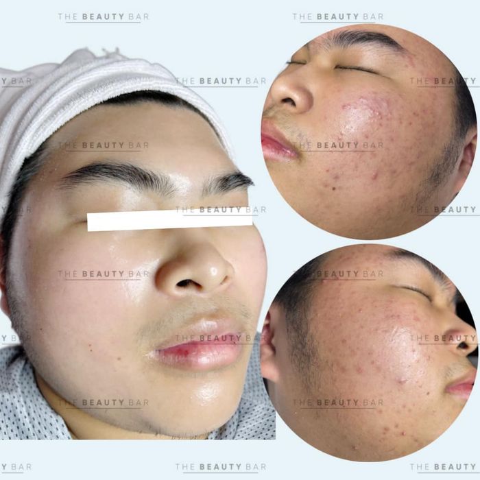 The Beauty Bar - Hình ảnh quy trình trị mụn chuyên nghiệp