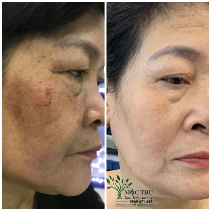 Hình ảnh quy trình điều trị nám chuyên nghiệp tại Mộc Thu Beauty Spa