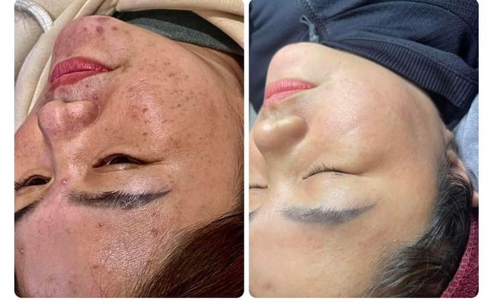 Quy trình điều trị chuyên nghiệp tại Lá Beauty & Spa