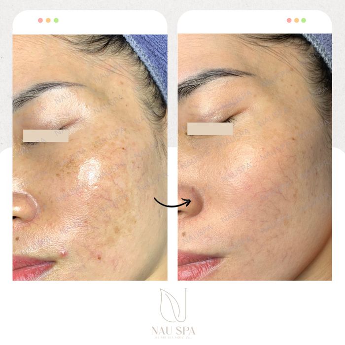 Hình ảnh thực tế quy trình điều trị tại Nâu Spa