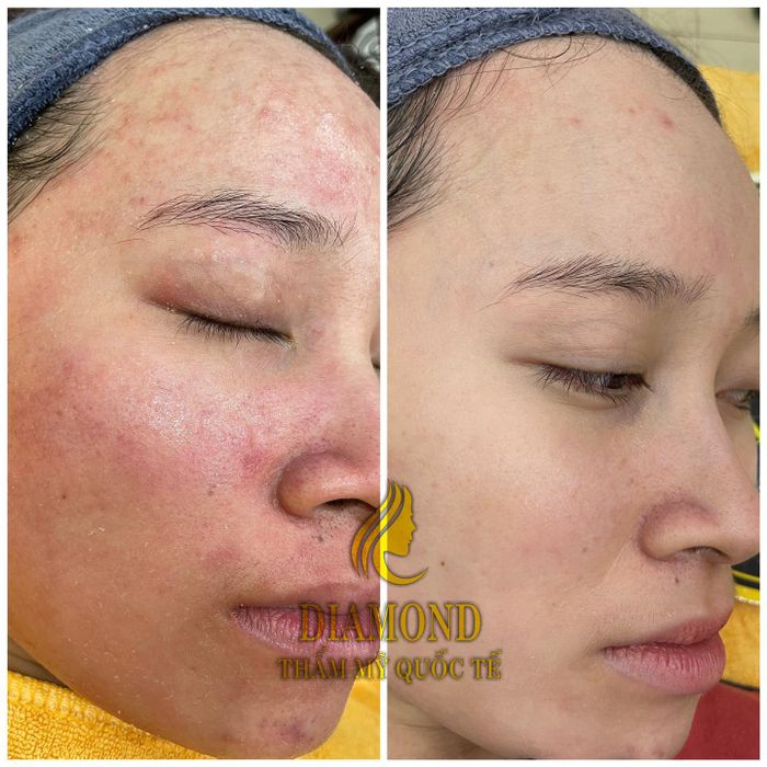 Hình ảnh kết quả điều trị nám ấn tượng tại Viện Thẩm Mỹ VENA