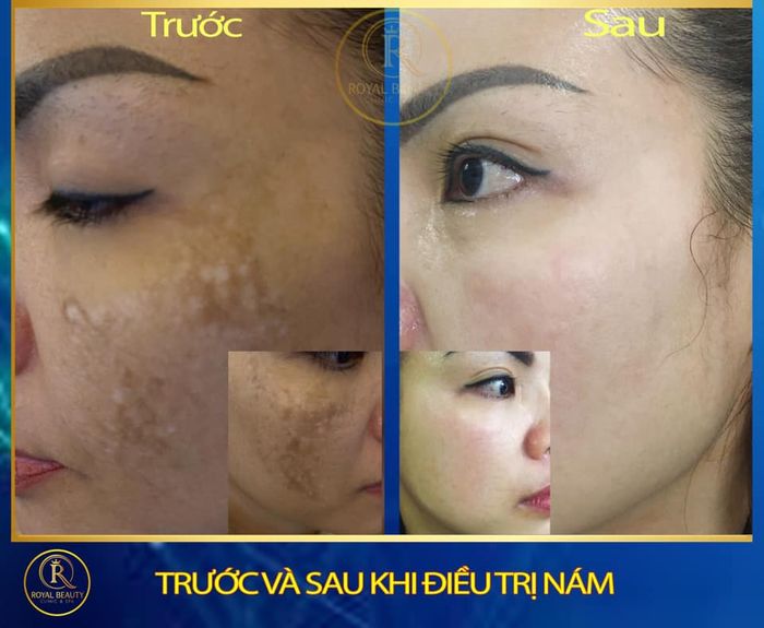 Hình ảnh quy trình điều trị chuyên nghiệp tại Spa Beauty Royal Quy Nhơn