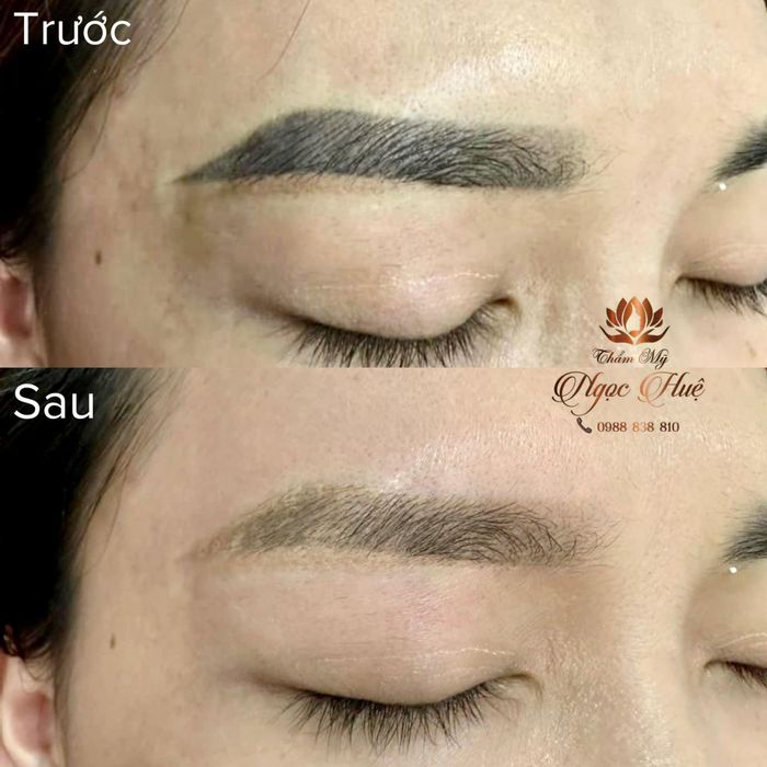 Hình ảnh kết quả xóa xăm ấn tượng tại Thẩm Mỹ Ngọc Huệ