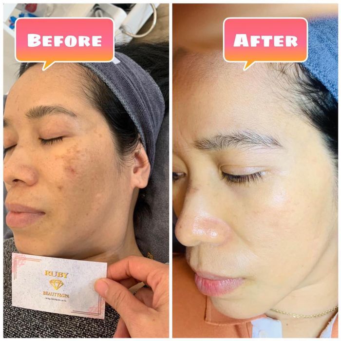 Hình ảnh thực tế liệu trình trị nám tại Ruby Beauty & Spa