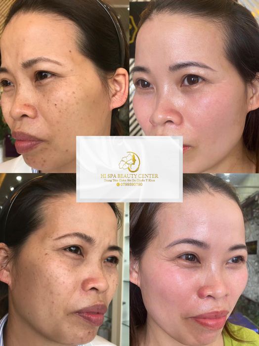Hình ảnh thực tế Hi Spa Vũng Tàu