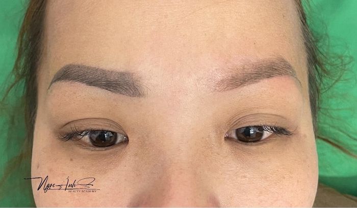 Hình ảnh thực tế quy trình xóa xăm tại Viện Thẩm Mỹ Ngọc Ánh