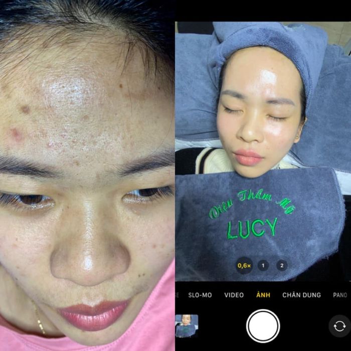Hình ảnh kết quả điều trị ấn tượng tại Viện Thẩm Mỹ LUCY