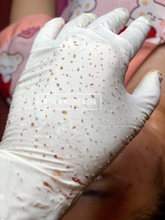 Quy trình trị liệu chuyên nghiệp tại Tiền Nguyễn Spa