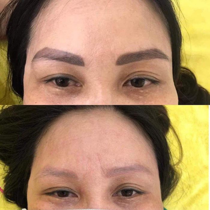 Hình ảnh thực tế quy trình xóa xăm tại Mine Beauty & Academy