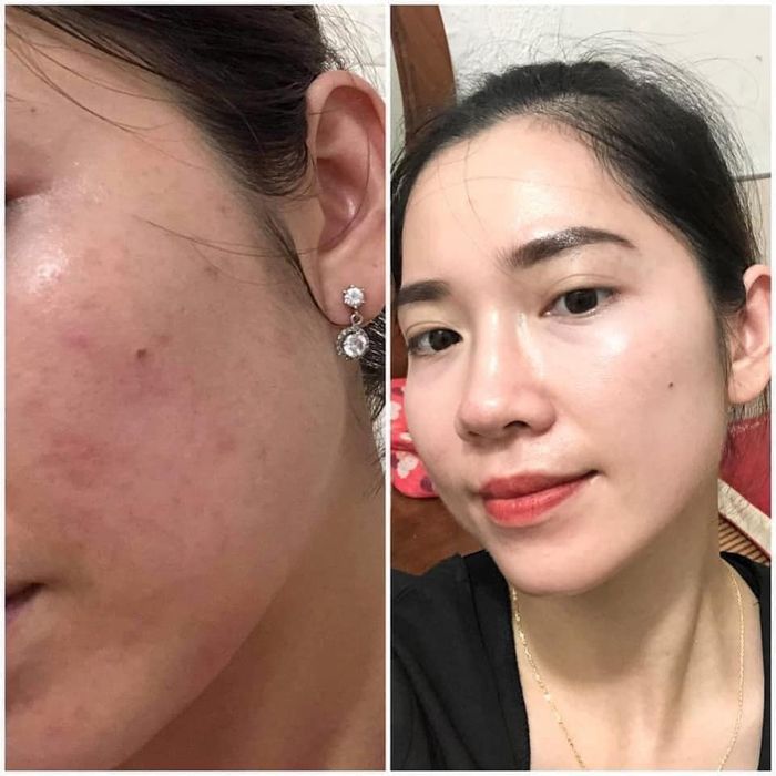 Hình ảnh trị liệu chuyên sâu tại MOON Beauty - Spa Quy Nhơn