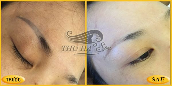Hình ảnh thực tế về dịch vụ xóa xăm tại Thu Hà Spa