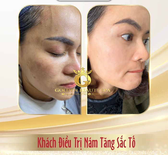 Quy trình điều trị chuyên nghiệp tại Golden Beauty Spa